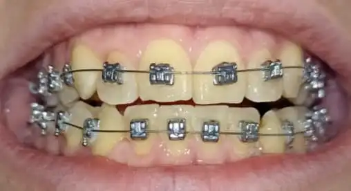 Antes del tratamiento de Sabino